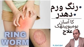 RINGWORM TREATMENT WITH HOMOEOPATHIC MEDICINESरिंग वर्म ट्रीटमेंटURDUHINDI DR AZHAR IQBAL [upl. by Ozner675]