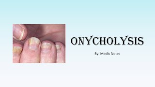 Onycholysis Plummers nail causes and pathophysiology [upl. by Eus70]