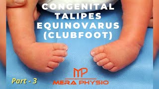 Congenital Talipes Equinovarus Clubfoot  pt 3  Physiotherapy Treatment  In Hindi  Mera Physio [upl. by Ortrude]