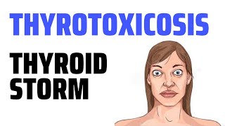 Thyrotoxicosis  Thyroid storm [upl. by Rashidi506]