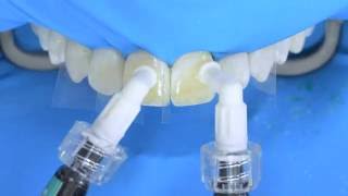 Fluorosis treatment using Icon infiltration step by step [upl. by Grosberg]