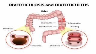 You Wont Believe What Happens Inside Your Colon viral [upl. by Ally]