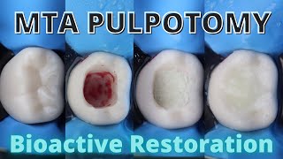 MTA PULPOTOMY 🟡 Bioactive Restoration 🟢 Step By Step [upl. by Alocin]