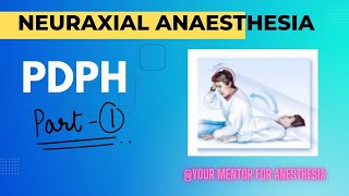 Post Dural Puncture Headache pathogenesis symptoms signs diagnosis [upl. by Niasuh]