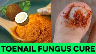 How To Treat Toenail Fungus With Turmeric amp Coconut Oil [upl. by Berard]