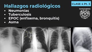 043  Neumonía TB EPOC Enfisema Bronquitis Bronquiectasias Asma [upl. by Efeek]