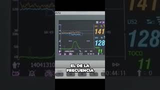 Cómo ESCUCHAR frecuencia Cardiaca Fetal Monitor fetal F6 [upl. by Afesoj926]