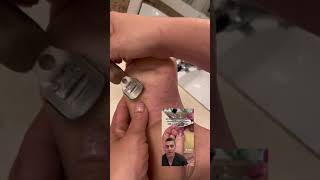 Podiatrist POV on EPPK Keratoderma Callus Hyperkeratosis and how I shave it  Jun 14 2023 [upl. by Lynnette]