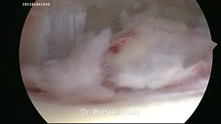 Arthroscopic Synovectomy Knee Joint  Septic Arthritis Knee  Dr Prateek Joshi [upl. by Leumek666]