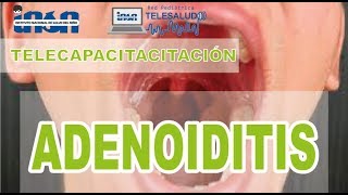 Adenoiditis  Telecapacitación INSN [upl. by Spence592]