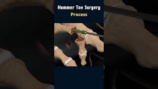 Hammer Toe Surgery Understanding the Procedure surgeryanimation [upl. by Domingo191]