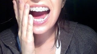 Why Im having Jaw Surgery Orthognathic [upl. by Annaul]