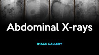 Abdominal Xrays Image Gallery [upl. by Goldfinch796]