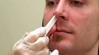 How To Treat Nosebleeds Epistaxis  Merck Manual Professional Version [upl. by Low]