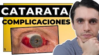 Molestias tras la Cirugía de Cataratas ➭ SENTIRÁS ESTO 👨🏻‍⚕️ 📄 Complicaciones parte 1 [upl. by Aikaz]