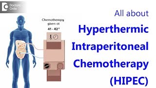 All about Hyperthermic Intraperitoneal ChemotherapyHIPEC [upl. by Domineca]