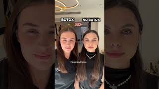 BOTOX VS NO BOTOX antiaging botulinumtoxin [upl. by Eillen]