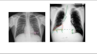 🔴 PNEUMONIE PLEURESIE INFARCTUS OU ATELECTASIE [upl. by Oiramat]