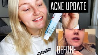 ACNE UPDATE  Duac gel  Rhiannon Mair [upl. by Macilroy830]