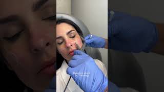 Beauty tips  Facial harmonization fillers botox [upl. by Botnick106]