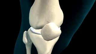 Knee Joint  Meniscus  3D Medical Animation  ABP © [upl. by Adnohsel]