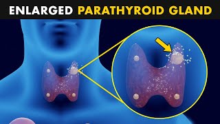 Hyperparathyroidism  Symptoms Causes And Treatment [upl. by Byrd]