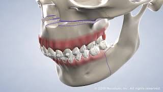 Jaw Surgery at Warren Orthodontics Springville UT [upl. by Meuse]