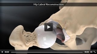 Hip Labral Reconstruction [upl. by Draper998]