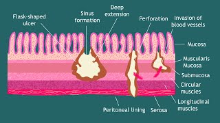 Pathogenesis of Entamoeba histolytica Notes  Parasitology  Basic Science Series [upl. by Naneek]