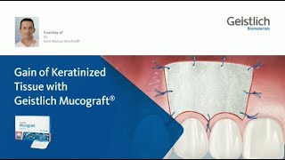 Geistlich Mucograft ile Keratinize Doku Kazanımı [upl. by Slorac]