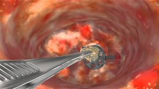 Animation Scar Tissue Removal to Release TORP [upl. by Atinihs78]