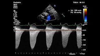 Basic echocardiography심장 초음파 기본  Coarctation of aorta대동맥 축착 [upl. by Nnahsal]