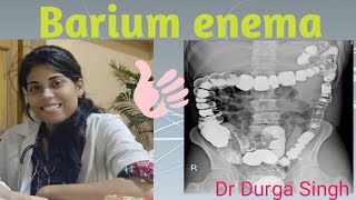 Barium enema  Part 5 in Barium series [upl. by O'Donovan]