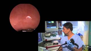 Pancreatic Cyst IPMN 1  Dr Anand Sahai MD [upl. by Tiras]