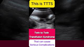 TTTS  Twin to Twin Transfusion Syndrome Ultrasound  Monochorionic TWINS [upl. by Nagaer]