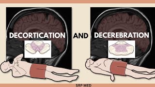 Decerebration vs Decortication  Understanding Neurological Postures amp Brain Damage [upl. by Aloibaf]