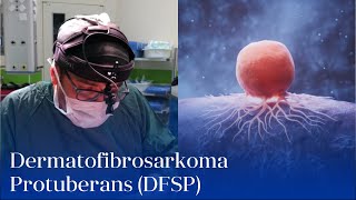 “Dermatofibrosarkoma Protuberans DFSP”  UzmDrDilqəm Məmmədov [upl. by Westphal]