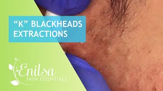 Blackheads Extractions “K’s” 2nd Treatment [upl. by Omura]