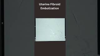 Uterine Fibroid Embolization [upl. by Proctor548]