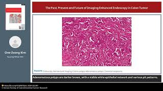 The Past Present and Future of Imaging Enhanced Endoscopy in Colon Tumor [upl. by Natye]