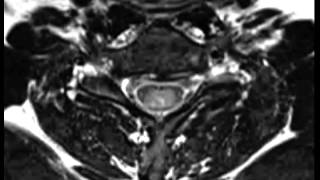 Spinal Ependymoma [upl. by Scoville]