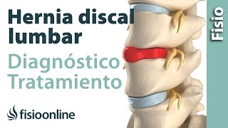 Hernia discal lumbar  Diagnóstico consejos ejercicios y tratamiento de fisioterapia [upl. by Aliuqaj442]