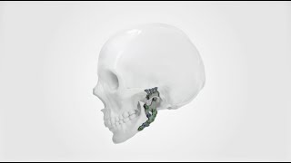 IPS Implants® TMJ Prosthesis [upl. by Hutchison507]