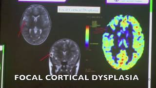 TMT ARTERIAL SPIN LABELING IN NEURORADIOLOGY [upl. by Alamaj]