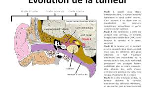 Les tumeurs de langle pontocérébelleux le neurinome de lacoustique [upl. by Aniryt]