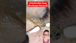 Chaotic BLACKHEAD REMOVAL UNDER EYE This Is Crazy shorts [upl. by Lonnard]