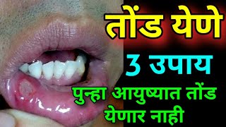 तोंड येणे वर घरगुती उपाय tond yene ayurvedic upay Mouth ulcer home remedy [upl. by Gyasi]