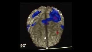 Kinesio effect on cortical brain activity fMRI [upl. by Damales]