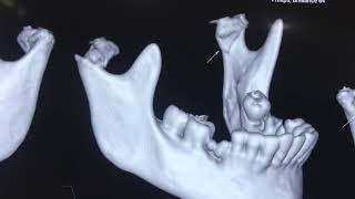 Bilateral High Sub Condylar Mandibular Fracture treatment [upl. by Ardnael]