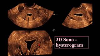 The Endometrium ultrasound [upl. by Htebyram]